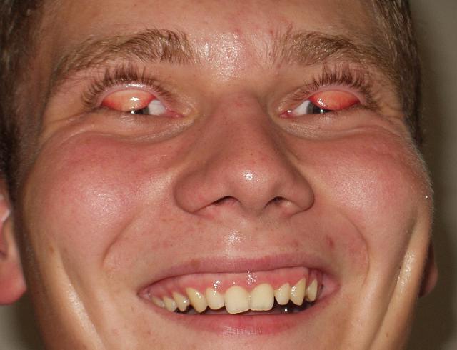 flippedeyelids.jpg